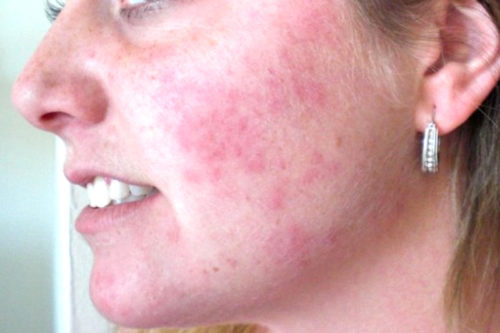 Аллергии кожи лица при беременности