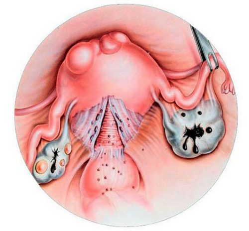 Рассосалась эндометриоидная киста яичника при беременности thumbnail
