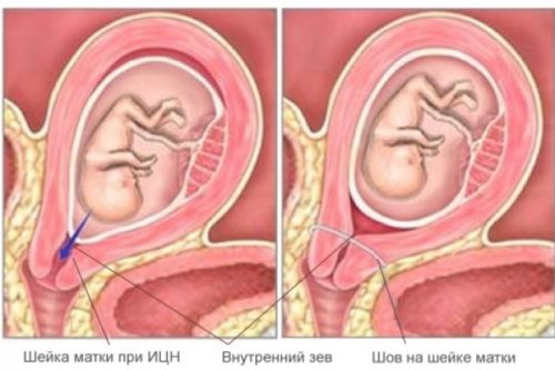 Колющие боли внизу живота при беременности на ранних thumbnail