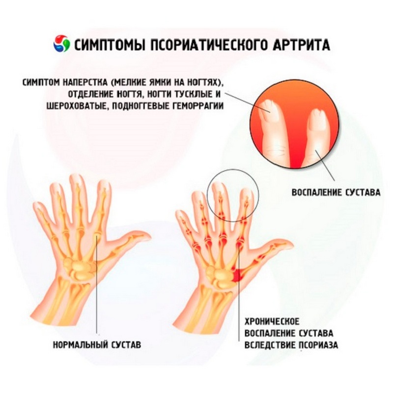 Болят суставы пальцев рук к какому врачу. Псориатический артрит симптомы. Клинические проявления псориатического артрита. Характерные суставные проявления ревматоидного артрита. Псориатический артрит поражение суставов.