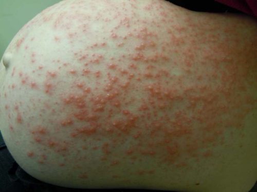 Аллергия при беременности в виде сыпи на животе