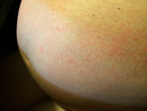 Сыпь на животе при беременности чешется