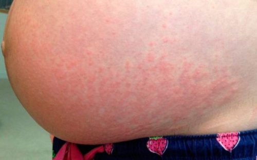 Сыпь на животе при беременности на ранних сроках